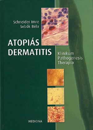 Atopiás dermatitis